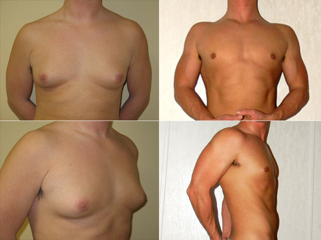 Recovering From Gynecomastia Male Breast Reduction Surgery | Orlando, FL |  Dr. George Pope
