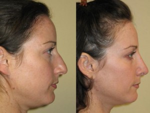 before and after image of rhinoplasty revision post