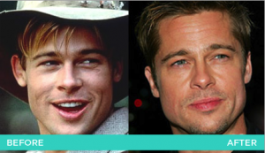 Octoplasty - Brad Pitt